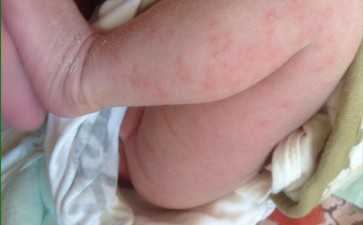 狼疮性肾炎可不可以怀孕 狼疮性肾炎可不可以做试管婴儿~~试管包男孩