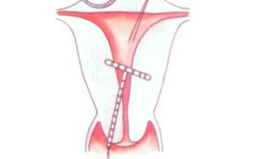 全国最出名的供卵医院,三代试管必须移植囊胚吗：三代试管必须是囊胚吗